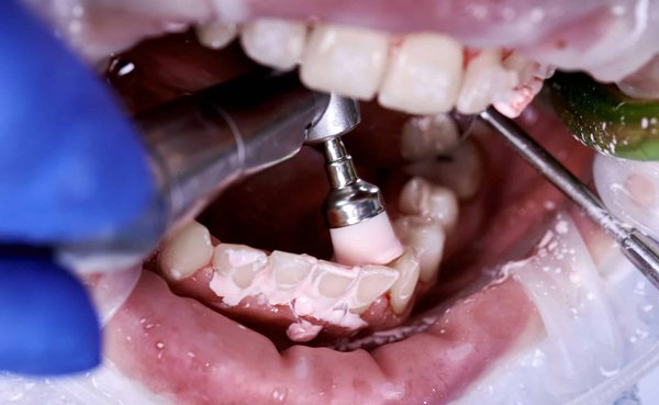 La clinique dentaire Prisma propose-t-elle des nettoyages dentaires réguliers ?